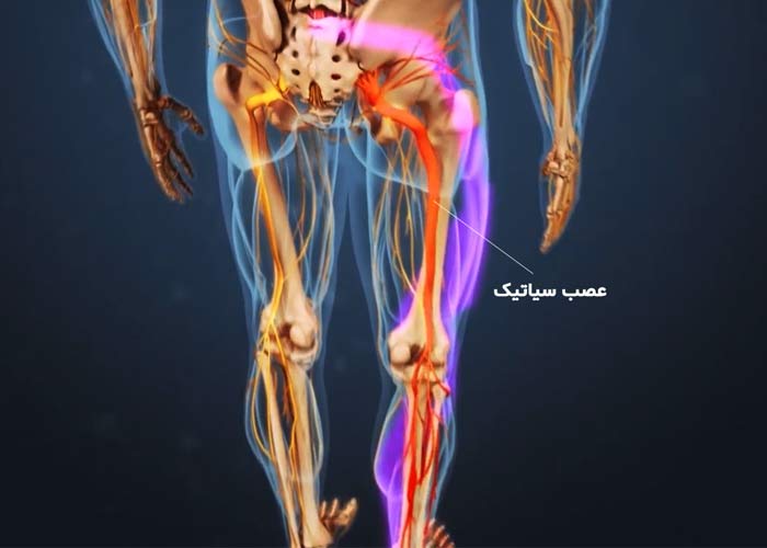 درمان سیاتیک برای همیشه؛ رهایی از درد سیاتیک با 12 روش خاص