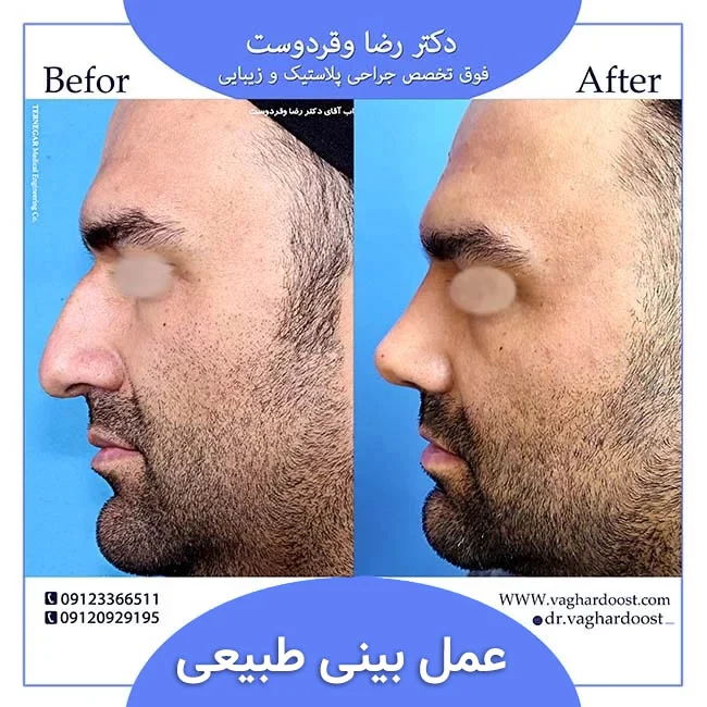 جراحی | جراحی بینی تفاوت جراحی بینی طبیعی با سایر جراحی های بینی