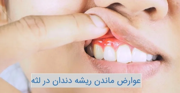عوارض ماندن ریشه دندان در لثه