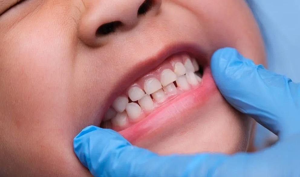 درمان | دندانپزشکی تعداد دندان شیری