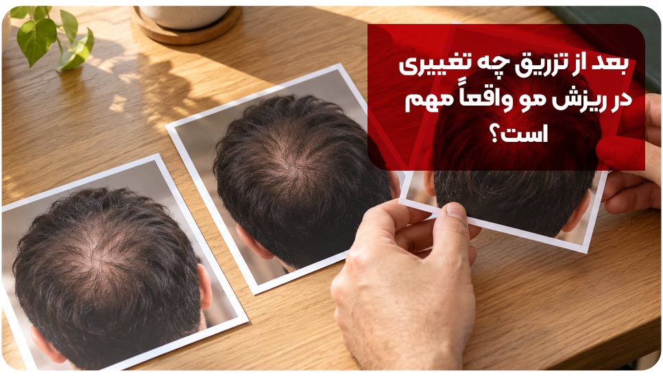 ریزش مو بعد از PRP؛ چرا تجربه افراد متفاوت است؟