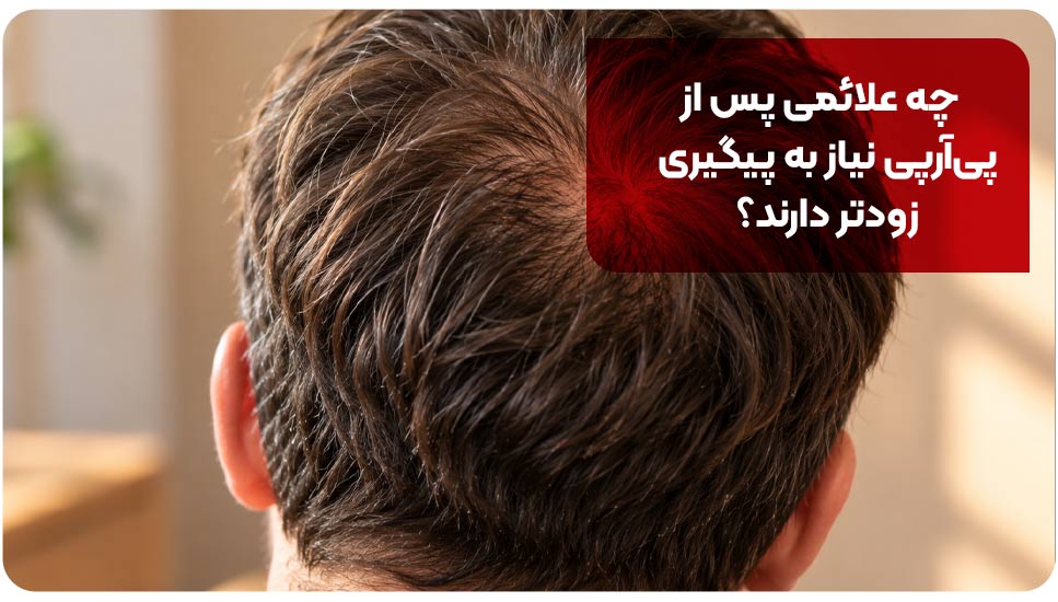 ریزش مو بعد از PRP؛ چرا تجربه افراد متفاوت است؟