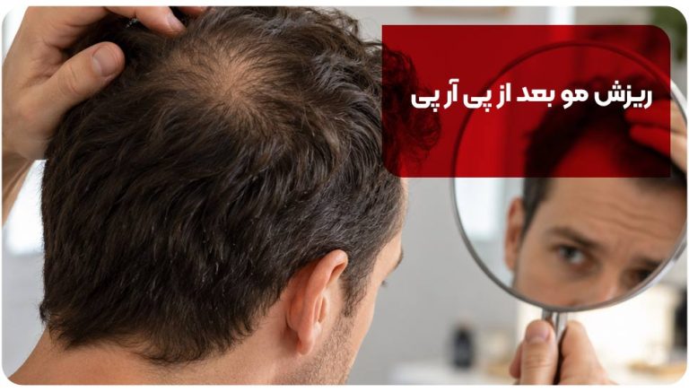ریزش مو بعد از PRP؛ چرا تجربه افراد متفاوت است؟