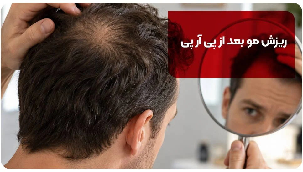 ریزش مو بعد از PRP؛ چرا تجربه افراد متفاوت است؟